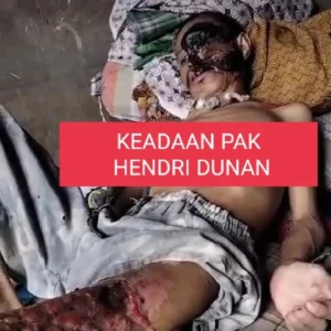 Idap Kanker, Warga Mukomuko Butuh Uluran Tangan