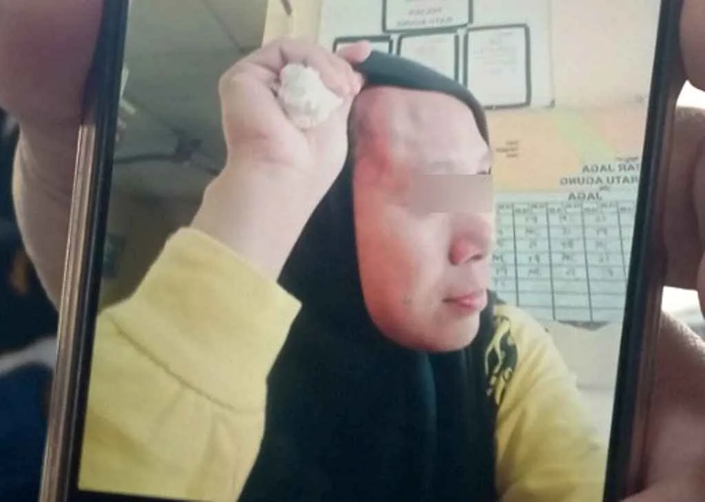 Murid Aniaya Guru Wanita Hingga Memar dan Benjol