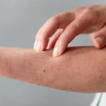 Memahami Penyakit Morgellons: Gejala, Penyebab, dan Pilihan Pengobatan