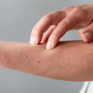 Memahami Penyakit Morgellons: Gejala, Penyebab, dan Pilihan Pengobatan