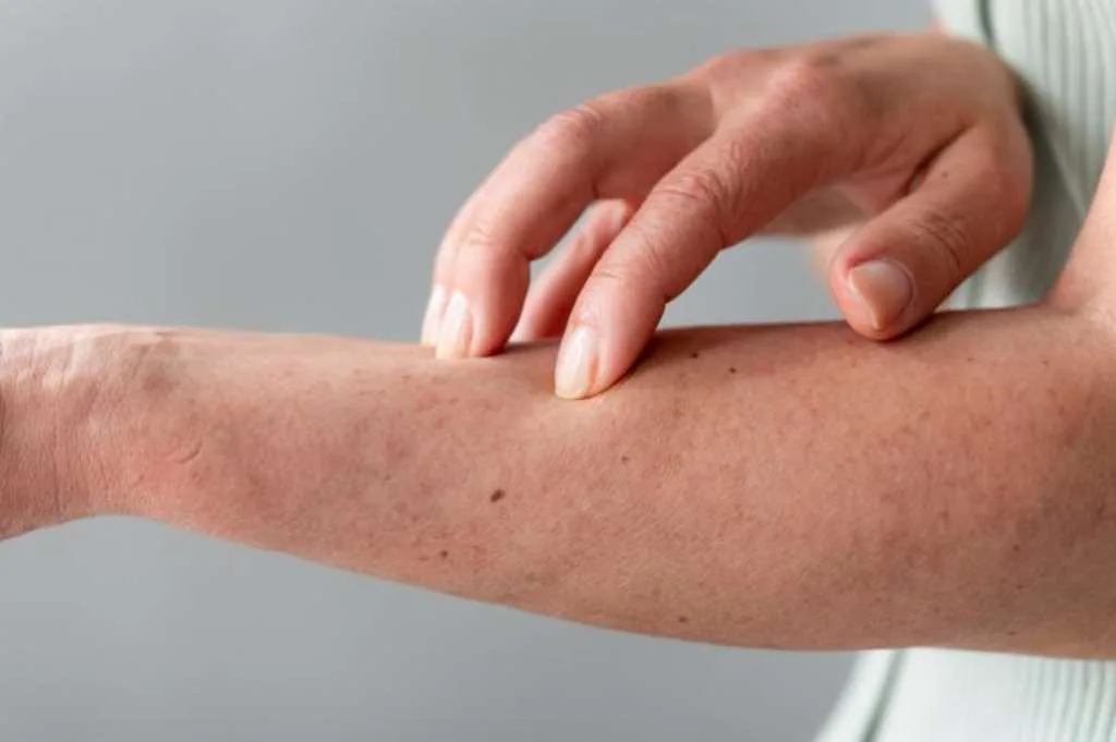 Memahami Penyakit Morgellons: Gejala, Penyebab, dan Pilihan Pengobatan