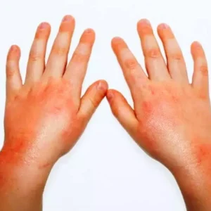 Cara Mengatasi Alergi pada Anak Cara Mengatasi Allergi pada Anak