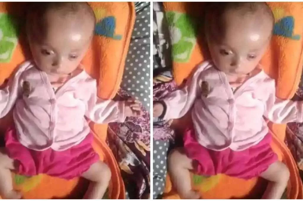 Idap Kelainan Sejak Lahir, Olivia Maharani Butuh Uluran Tangan DermawanÂ 