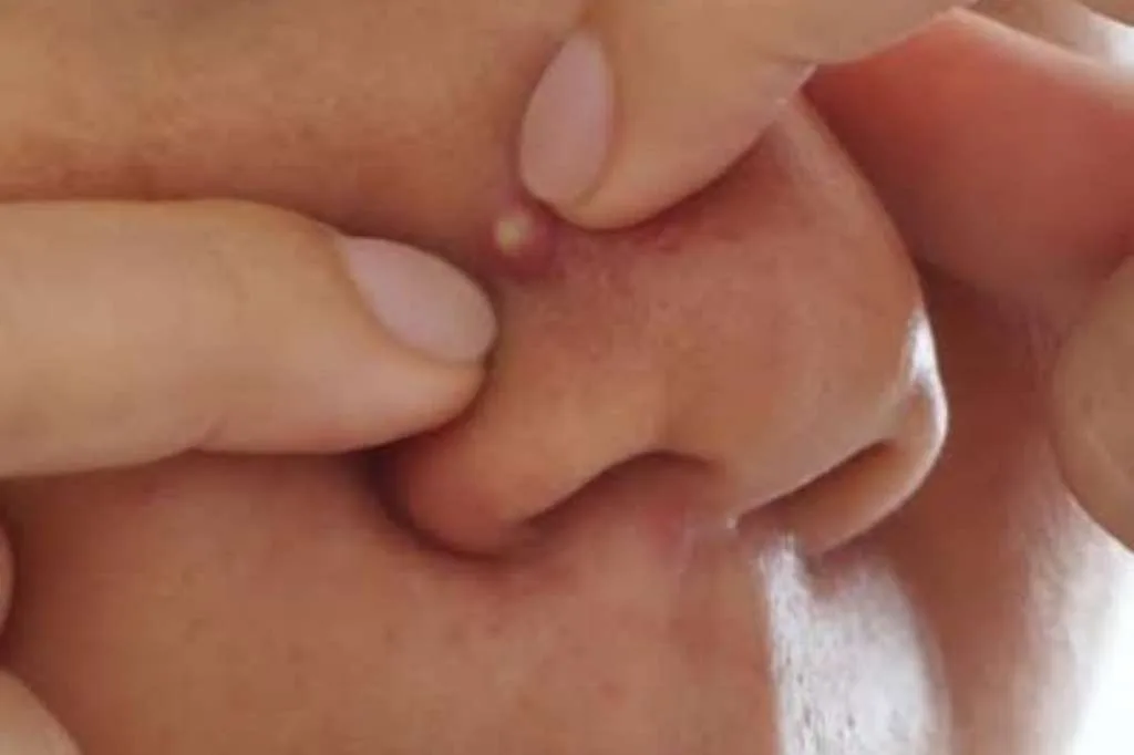 Bahaya Memencet Jerawat di Hidung, Bisa Sebabkan Infeksi ke Otak?