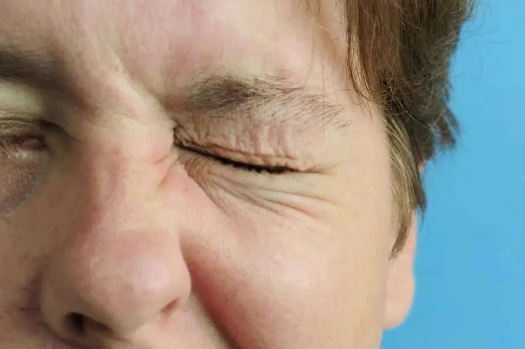 Perbedaan Stroke dan Bell’s Palsy, Gejala dan Penyebab yang Perlu Diketahui