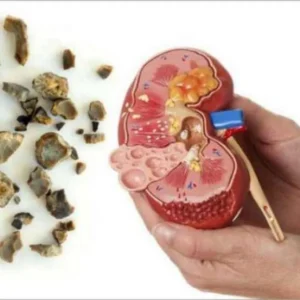 Punya Komplikasi Batu Ginjal? Coba Rutin Minum Ini Punya Komplikasi Batu Ginjal? Coba Rutin Minum Ini