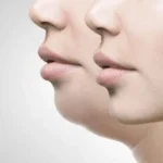 Cara Efektif Menghilangkan Double Chin, Ini Pilihan Alami dan Medis