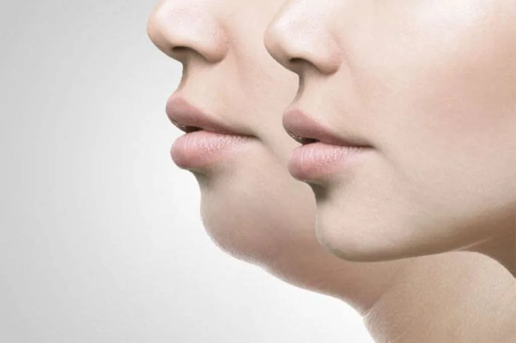 Cara Efektif Menghilangkan Double Chin, Ini Pilihan Alami dan Medis