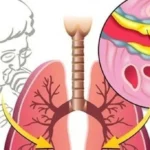 Ternyata Ini Cara Mudah Hilangkan Lendir Tenggorokan saat Flu