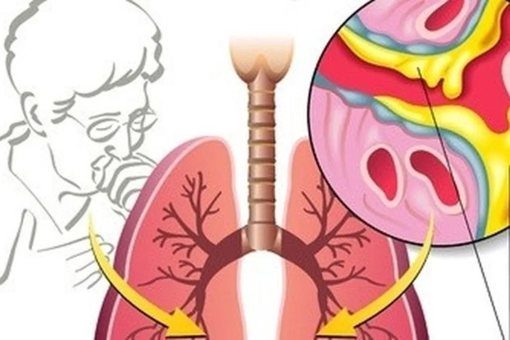 Ternyata Ini Cara Mudah Hilangkan Lendir Tenggorokan saat Flu