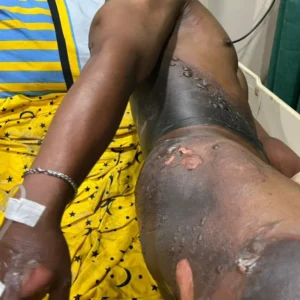 Sakit Hati, Seorang Wanita Bakar Mantan Pacar Hingga Luka Parah