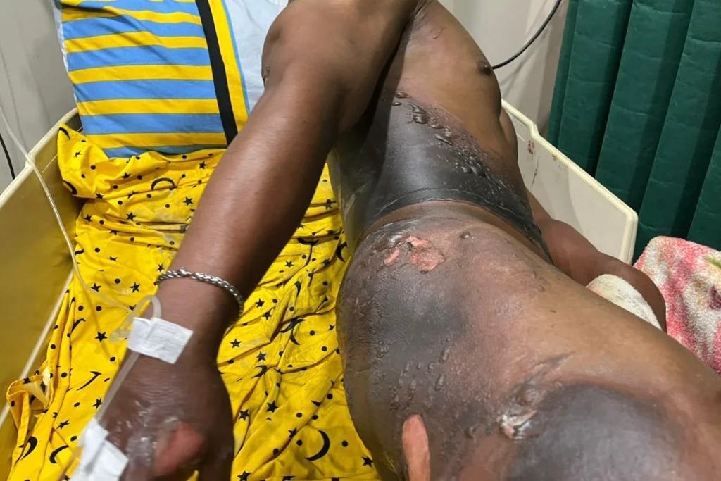 Sakit Hati, Seorang Wanita Bakar Mantan Pacar Hingga Luka Parah
