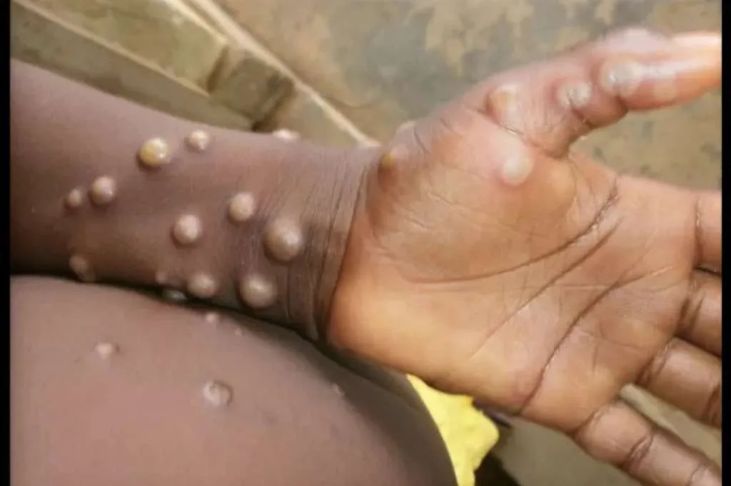 Wabah Mpox Meningkat, WHO Serukan Respons Global Terpadu Vaksin Mpox Kini Tersedia di Indonesia, Vaksinasi Dianjurkan untuk Golongan Ini